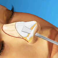 Virtual Nose Job Surgery