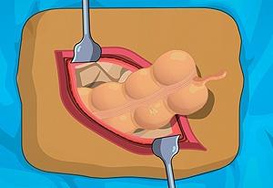 play Operate Now: Appendix Surgery