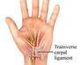 play Carpal Tunnel