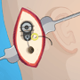 Ear Surgery