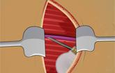 play Pacemaker Surgery