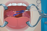 play Tonsil Surgery
