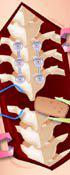 play Anna Scoliosis Surgery