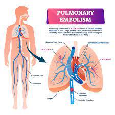 play Pulmonary Embolism Algorithm