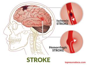 play Acute Stroke: Complete Algorithm