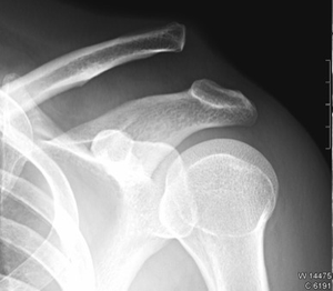play Luxación Acromioclavicular